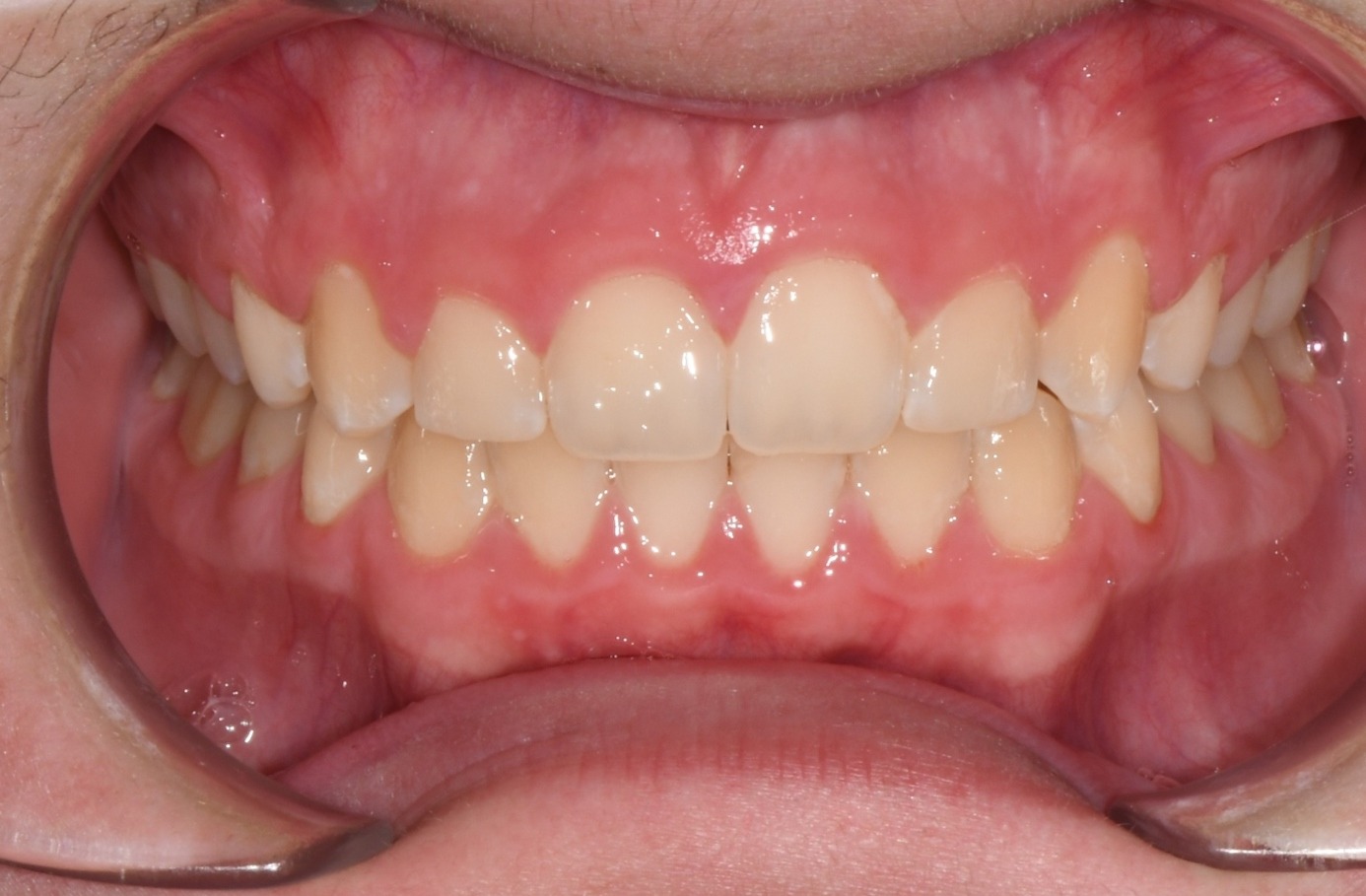 after Image