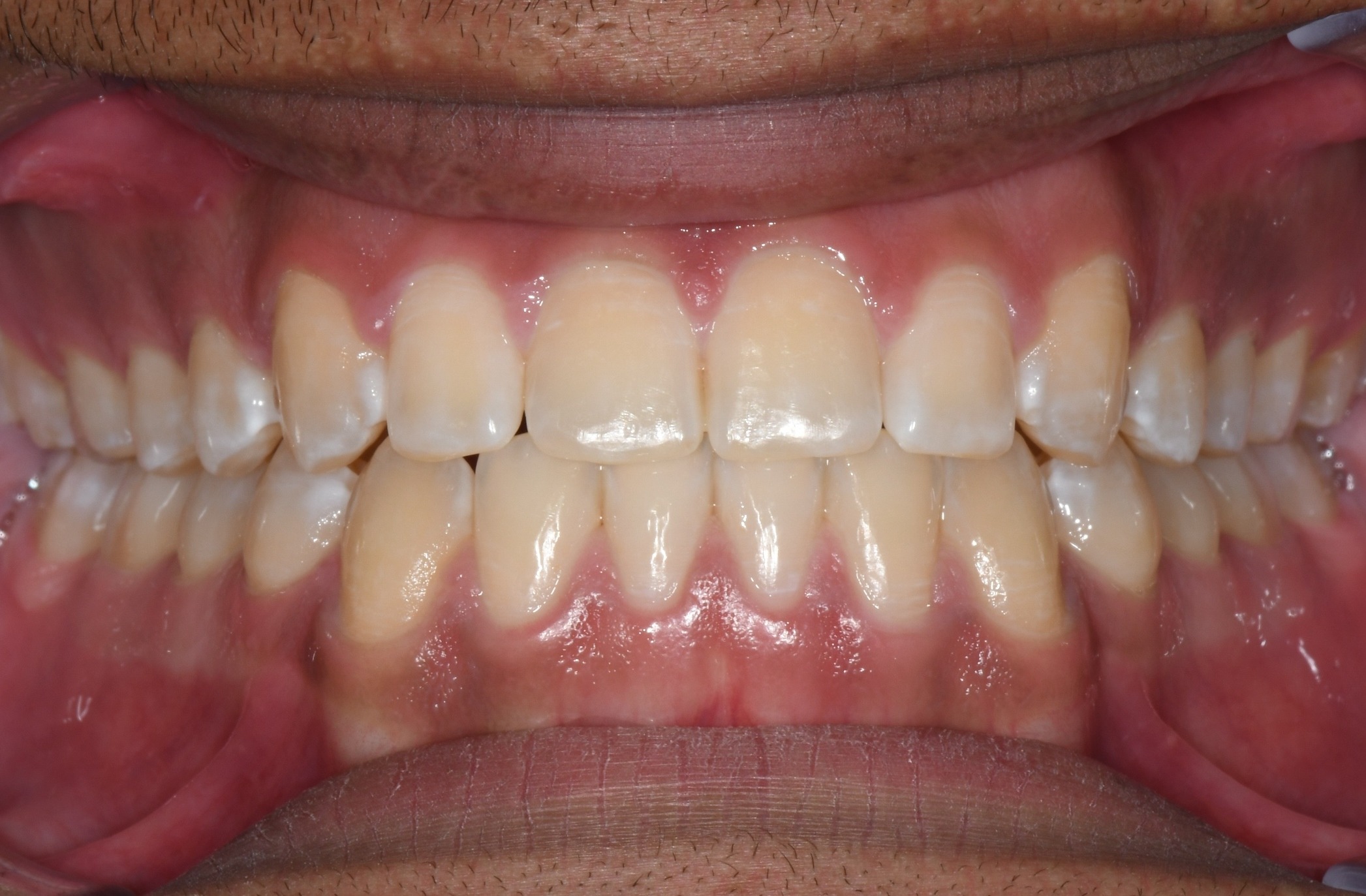 after Image