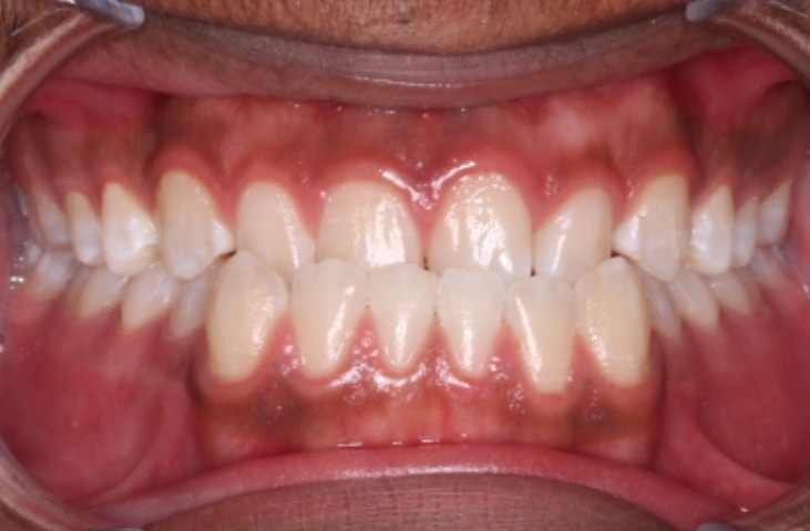 before Image