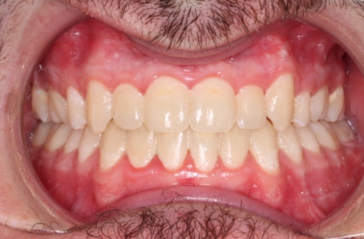 after Image