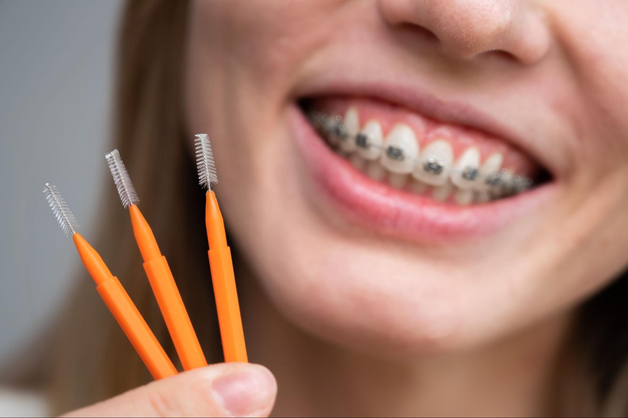 How To Care for Your Smile After Braces